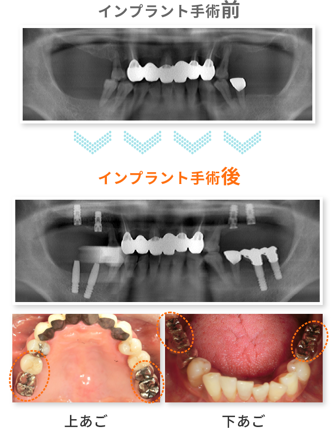 インプラント手術前 & インプラント手術後